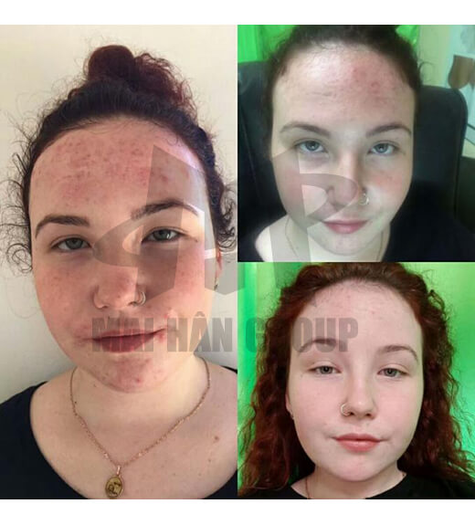 Máy cung cấp Oxy đa chức năng KES-400 Máy cung cấp Oxy đa chức năng KES-400